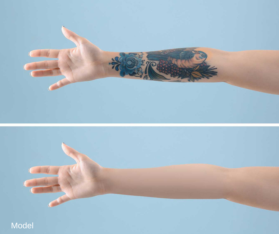 Laser Tattoo Removal: Step-by-Step | Dr. Jerome Potozkin